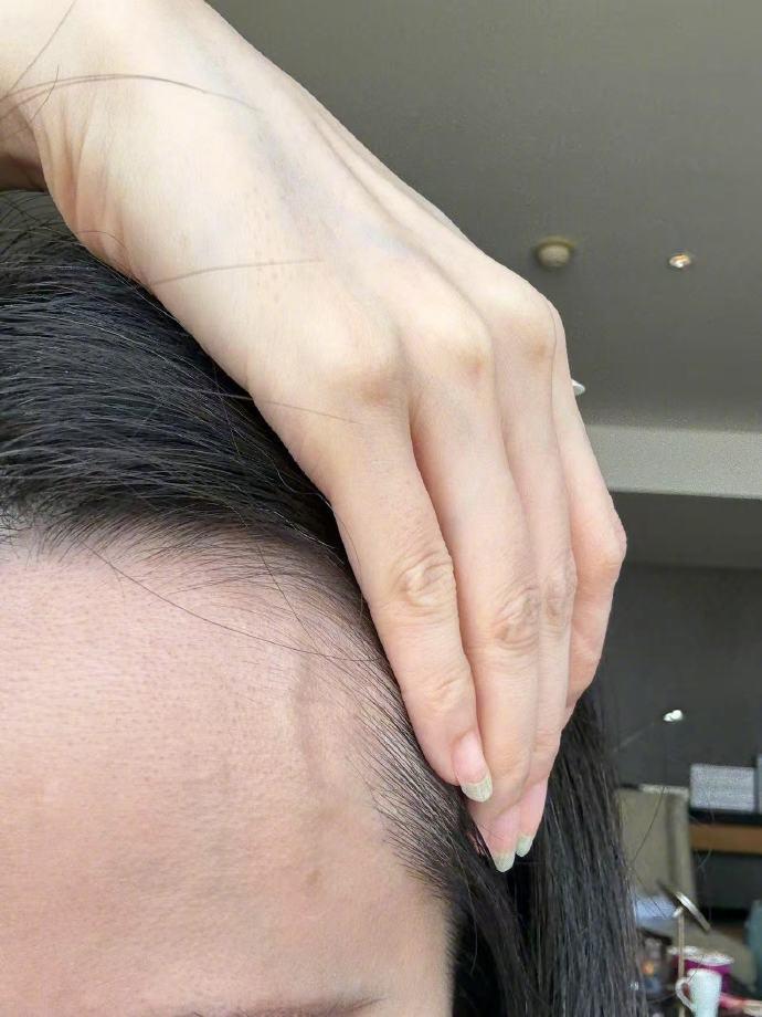 张靓颖自曝体检营养不良，额头血管莫名突起，伸个懒腰手掌就流血了 ...